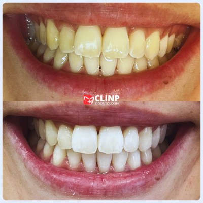 clareamenot-clinp-odontologia
