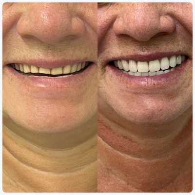 lente-em-resina-clinp-odontologia