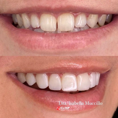 lente-em-resina-clinp-odontologia2