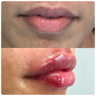 preenchimento-labial-clinp-odontologia