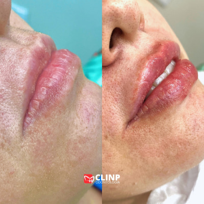 preenchimento-labial-clinp-odontologia2