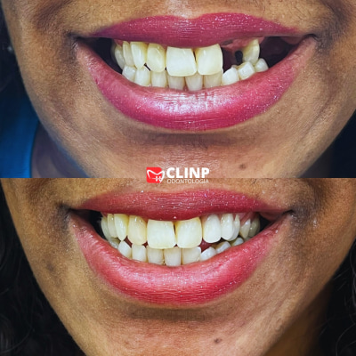 protese-clinp-odontologia